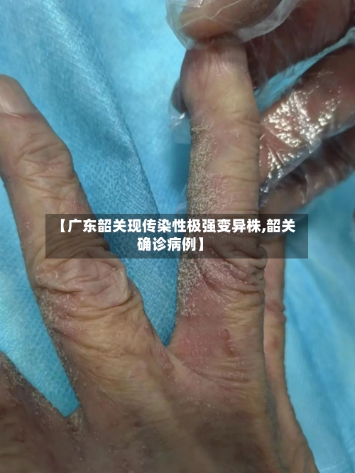 【广东韶关现传染性极强变异株,韶关确诊病例】-第2张图片
